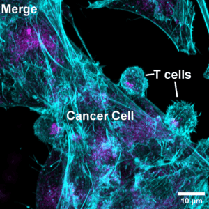 Human cytotoxic T cells were mixed with CD19-expressing cancer cells in the presence of a CD3–CD19 BiTE and then fixed. F-actin (cyan) and lysosomes (magenta) areshown. Notice how T cell lysosomes gather at the contact point, ready to deliver their cytotoxic payload