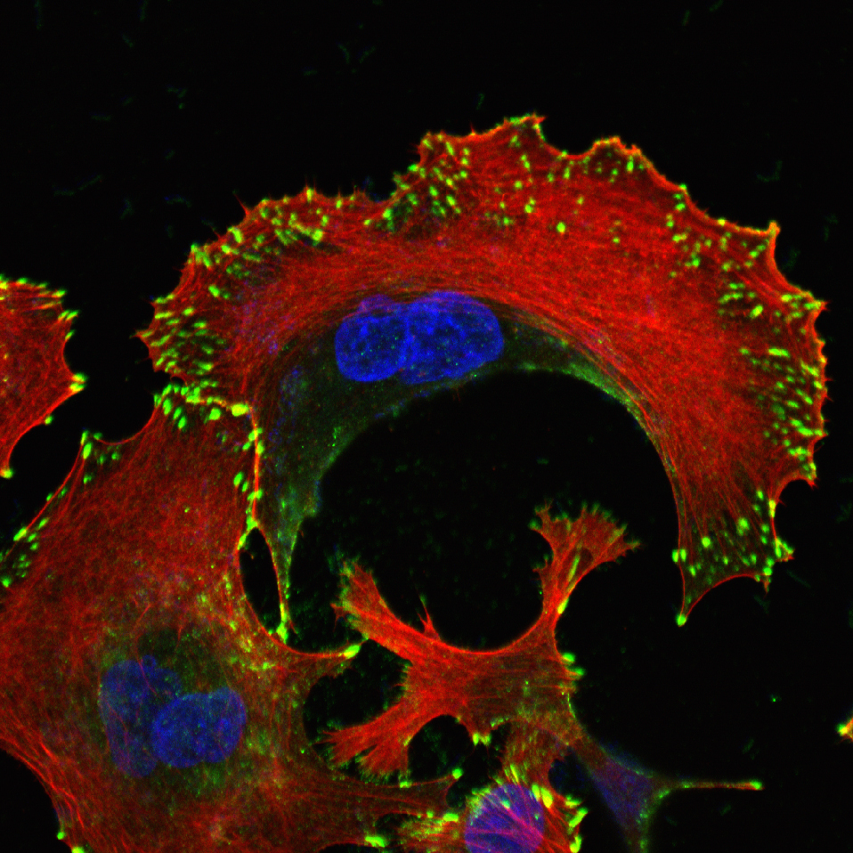 Nahaufnahme Krebszellen