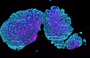 Magengewebe von Patienten mit bakterieller Infektion (Helicobacter pylori)