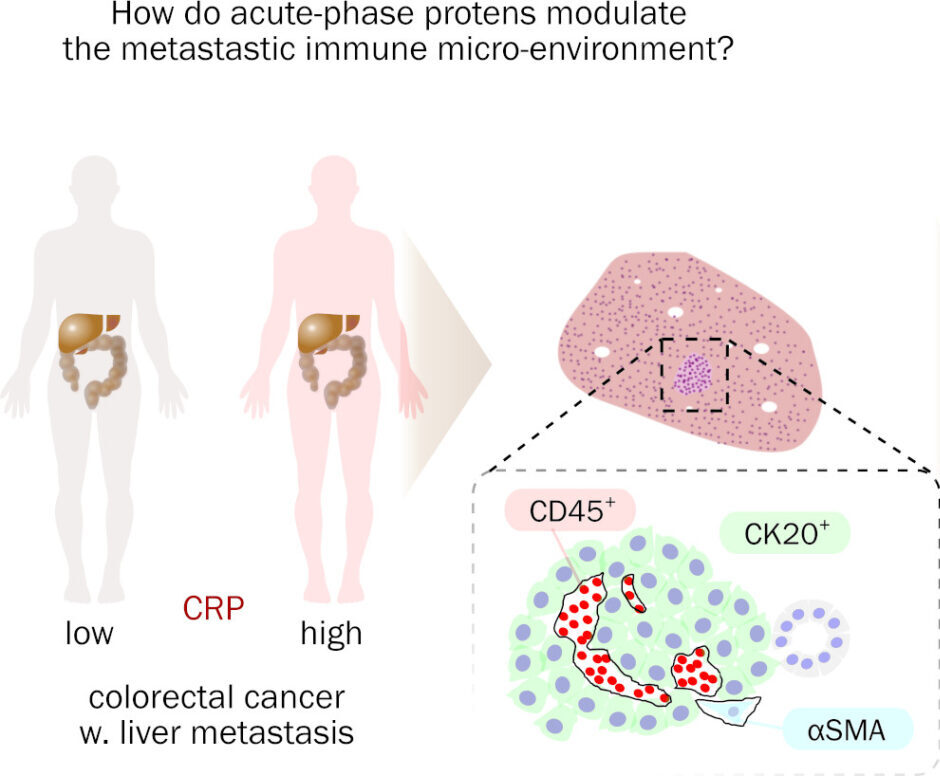 Acute phase proteins in liver metastasis